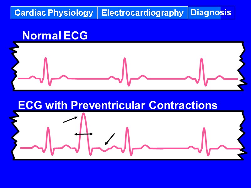 Cardiac Physiology Electrocardiography Diagnosis ECG with Preventricular Contractions Normal ECG